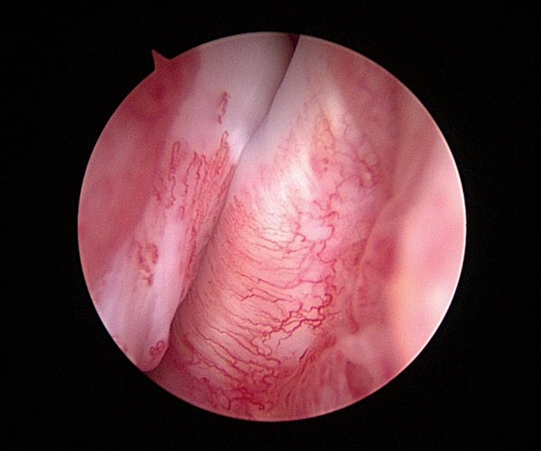 Epaule arthroscopie.